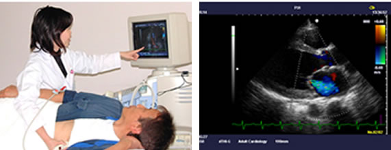 心臓超音波検査
